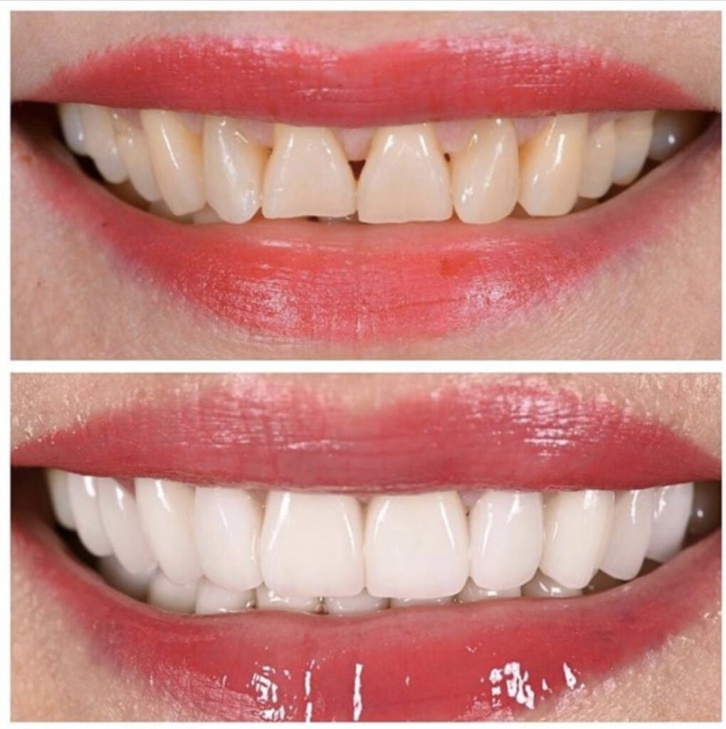 Non-Surgical Facelift Before and After Photos