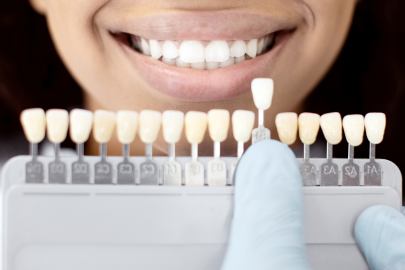 A person smiling while a gloved hand at the dental clinic holds a shade guide with different tooth colors in front of their mouth, selecting a shade that matches their teeth.