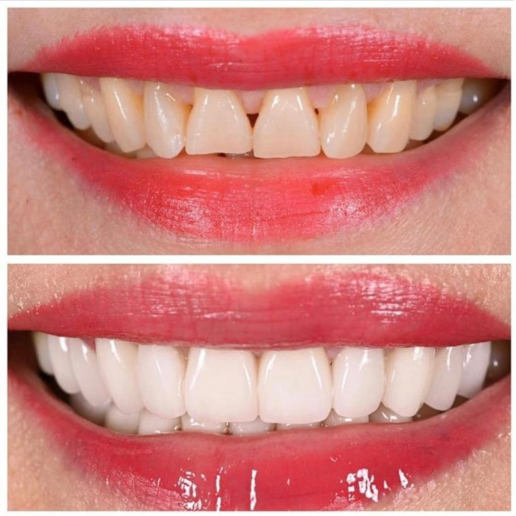 Close-up comparison of two smiles: the top image shows natural teeth with exposed gums, while the bottom displays a whiter, even smile with less visible gums, highlighting results achievable at a Dental Clinic.