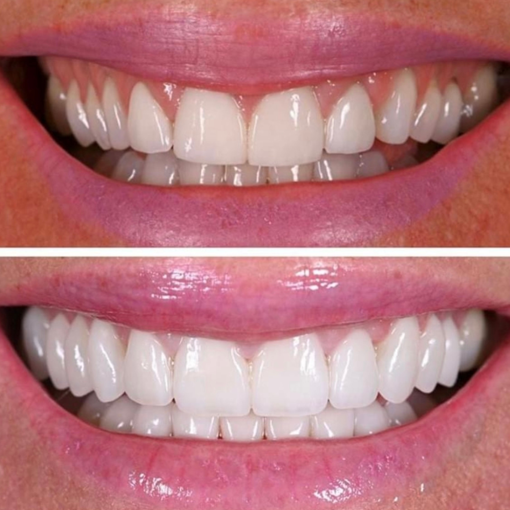 Close-up comparison of two smiles: the top image shows natural teeth with exposed gums, while the bottom displays a whiter, even smile with less visible gums, highlighting results achievable at a Dental Clinic.