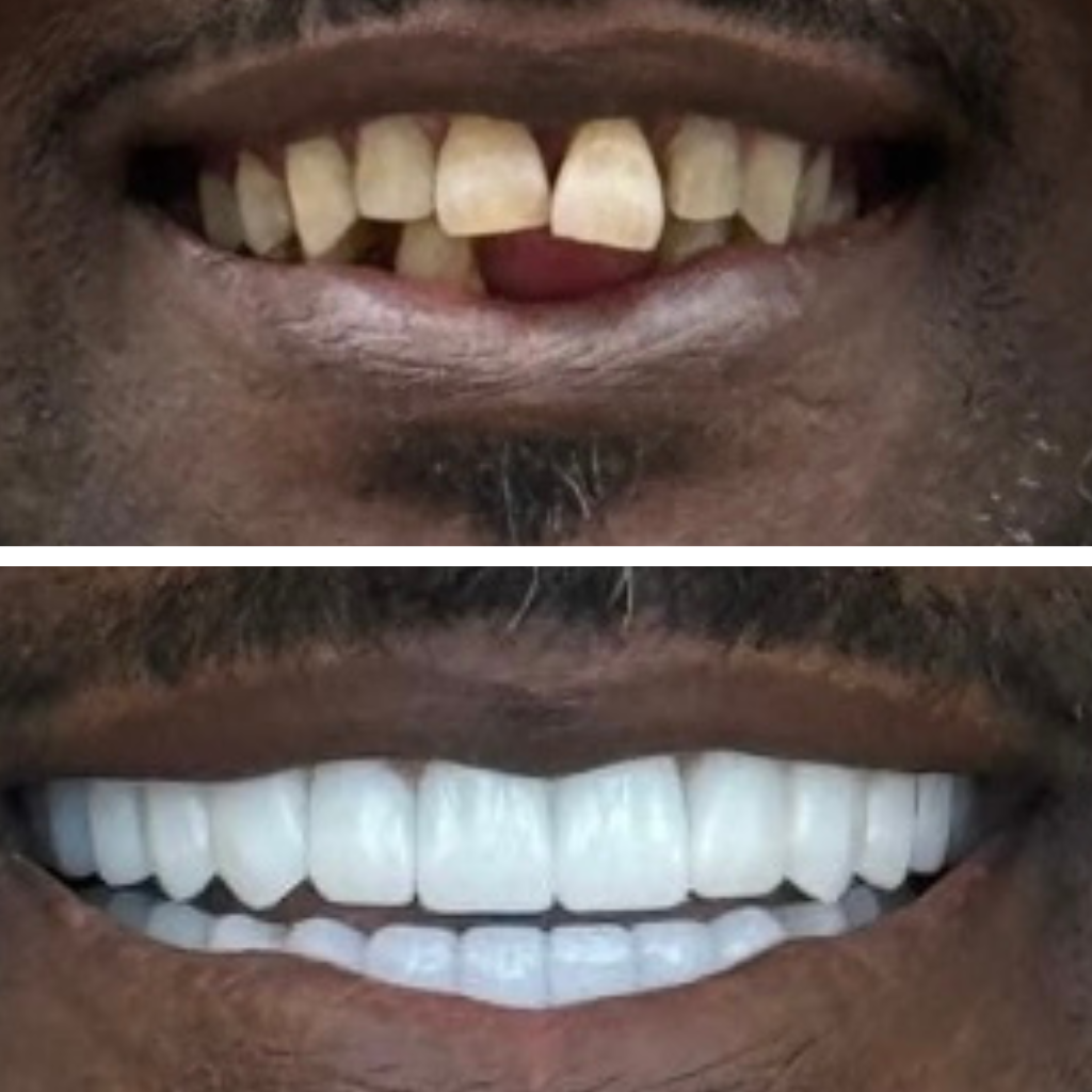 A split image shows a persons smile before and after visiting a Dental Clinic; the top displays uneven, discolored, and missing teeth, while the bottom reveals straight, white, perfectly aligned teeth.