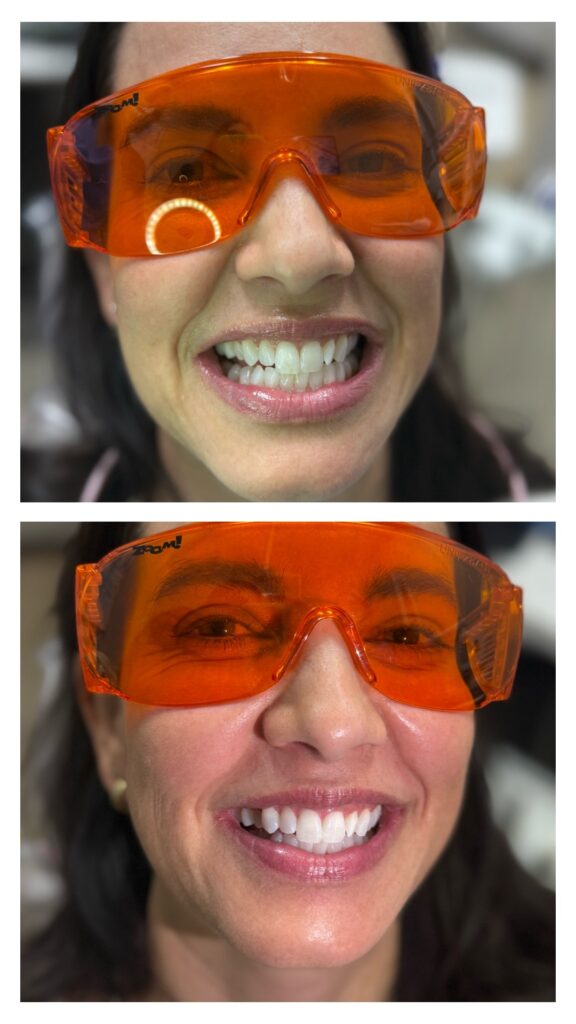 Before-and-after photos of a woman’s smile after teeth whitening treatment.