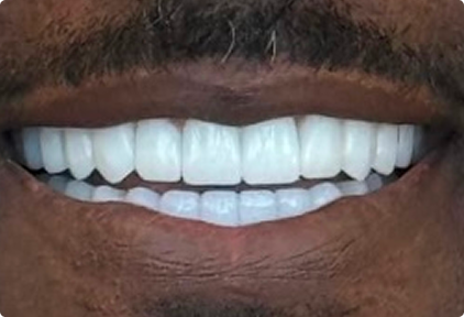 A close-up of a persons mouth showing bright white, even teeth and a mustache above the upper lip.