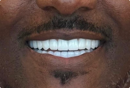 A close-up of a persons mouth smiling, showing straight, white teeth. The person has a mustache and a small patch of facial hair below the lower lip.